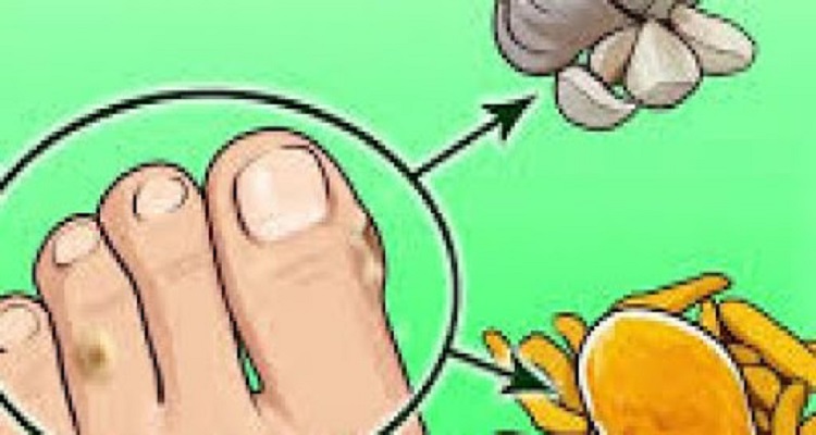 درمان میخچه